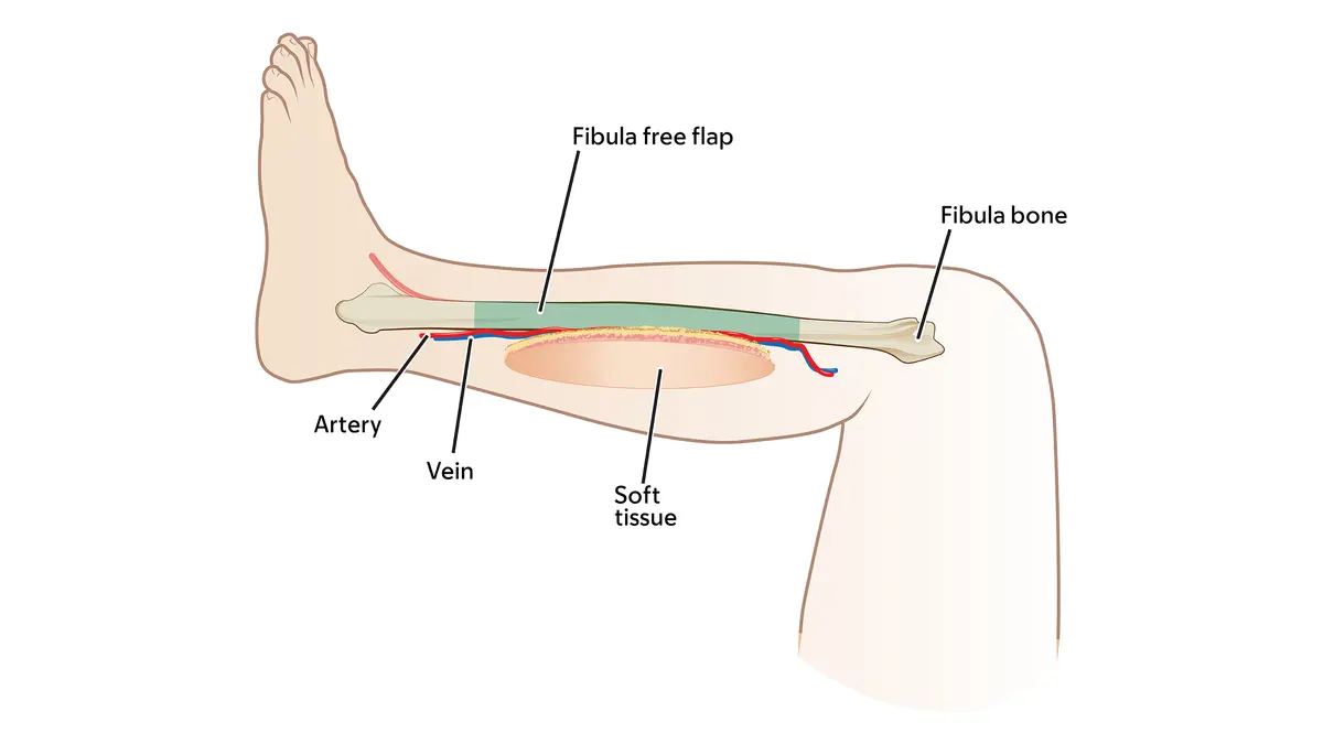 Illustration of a fibula free flap, showing bone, an artery, vein, and soft tissue. 