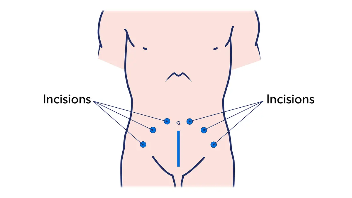 Illustration showing where a surgeon makes small cuts for a laparoscopic or robot-assisted prostatectomy 