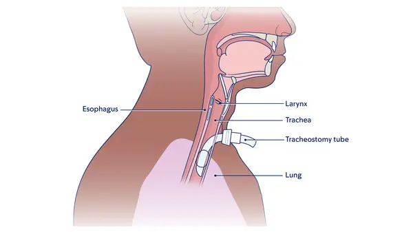 Illustration of placement of a tracheostomy tube, including the larynx, trachea, esophagus, lung, and tracheostomy tube. 