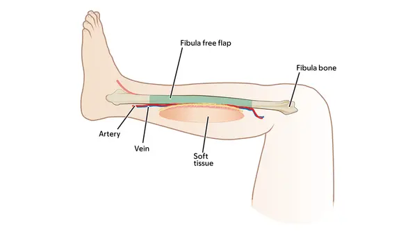 Illustration of a fibula free flap, showing bone, an artery, vein, and soft tissue. 