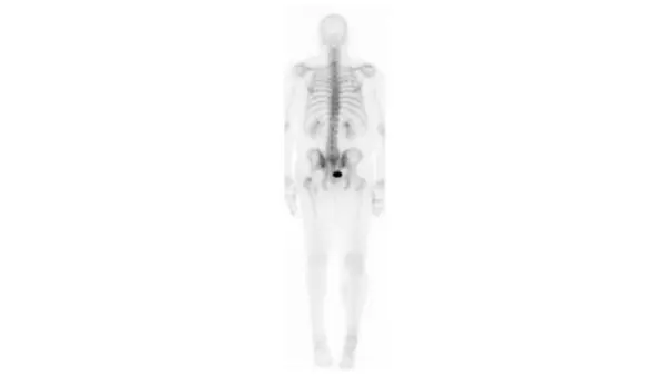 A bone scan image shows a skeleton with a black dot near the prostate.  