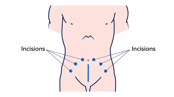 Illustration showing where a surgeon makes small cuts for a laparoscopic or robot-assisted prostatectomy 